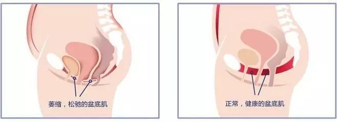 老公说你「松」了？图解「凯格尔」缩阴训练法缩略图