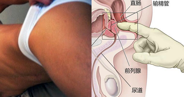 取前列腺液没想象中那么痛苦缩略图